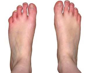 diabetische voet zwelling en verkleuringen tenen
